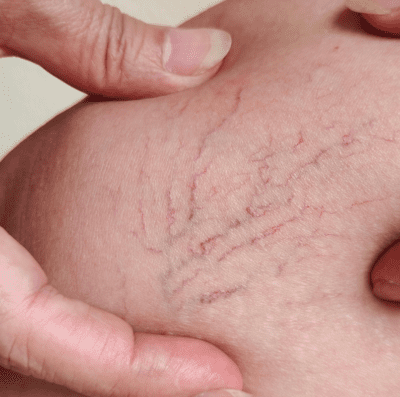 Varizes vão além da estética; veja como tratar (Foto: Canva)